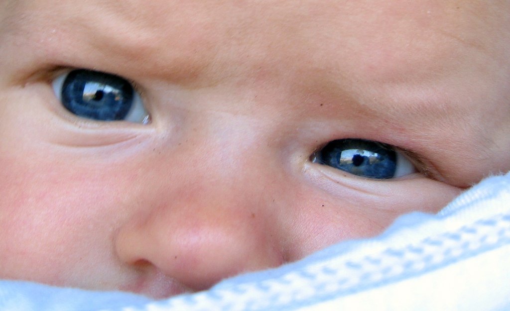 Retinoblastoma